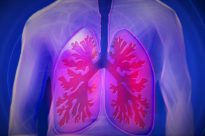 Catching Lung Cancer Early With Regular CT Screening